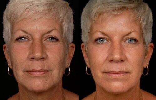 Das Ergebnis der Laserbehandlung der Gesichtshaut – Faltenreduzierung