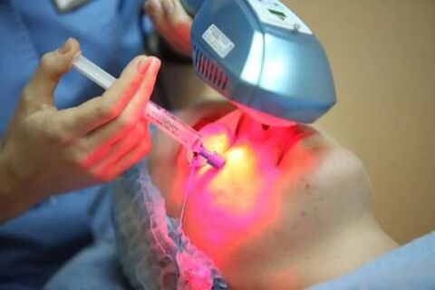 Laser-Biorevitalisierung der Gesichtshaut