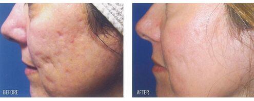 Vor und nach der Anwendung des Lasergeräts auf der Haut mit Narben