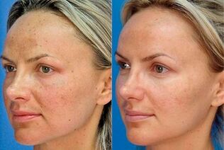 Foto vor und nach der Hautverjüngung mit dem Gerät